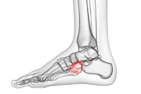 Cuboid Syndrome Is a Hidden Source of Foot Pain