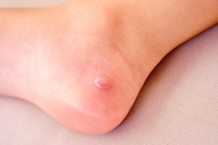 Causes of and Caring for Blisters